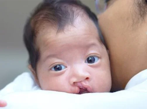 Best hospital for cleft palate surgery in india