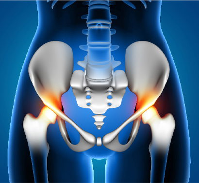 Hip replacement surgery India