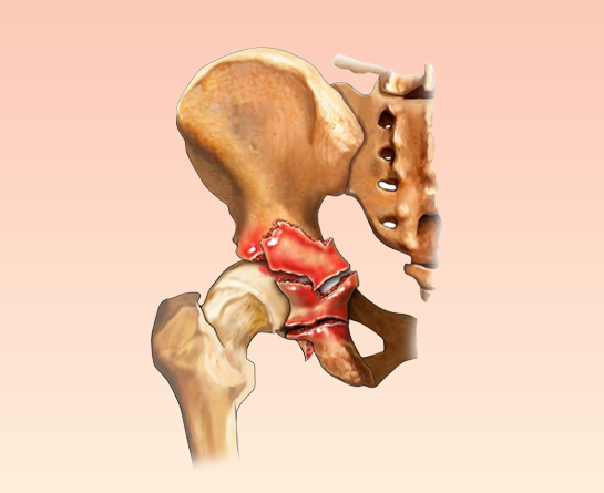 Hospital is Best for Acetabular Fracture Surgery in India