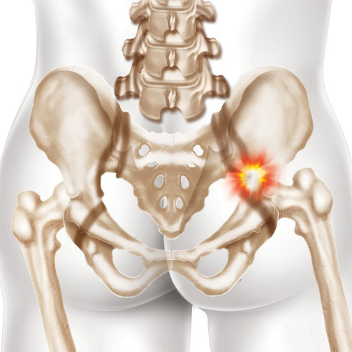 Acetabular Fracture  Treatment India