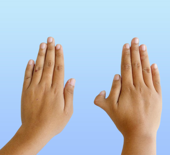 Congenital Hand Deformities Hospital