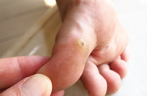 Diabetic foot ulcer Treatment medication