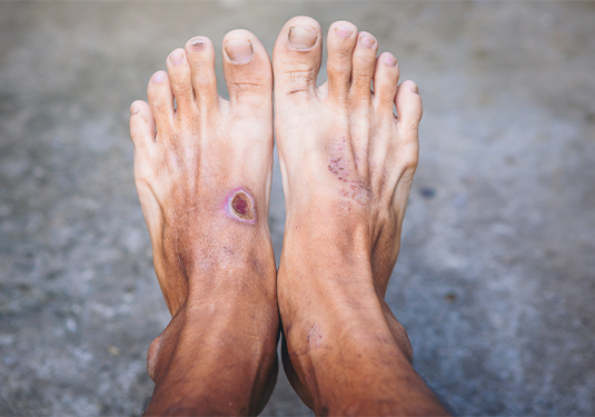 Best Diabetic Foot Ulcer Treatment