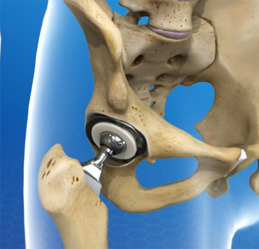 Minimally invasive hip surgery India