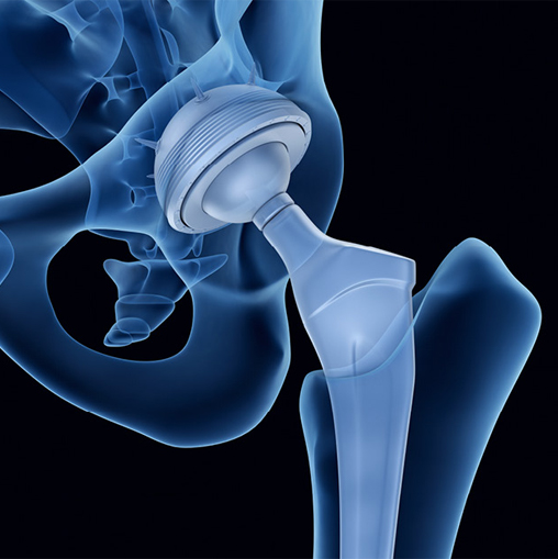 Hip joint replacement treatment India