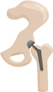 Total hip replacement cost India