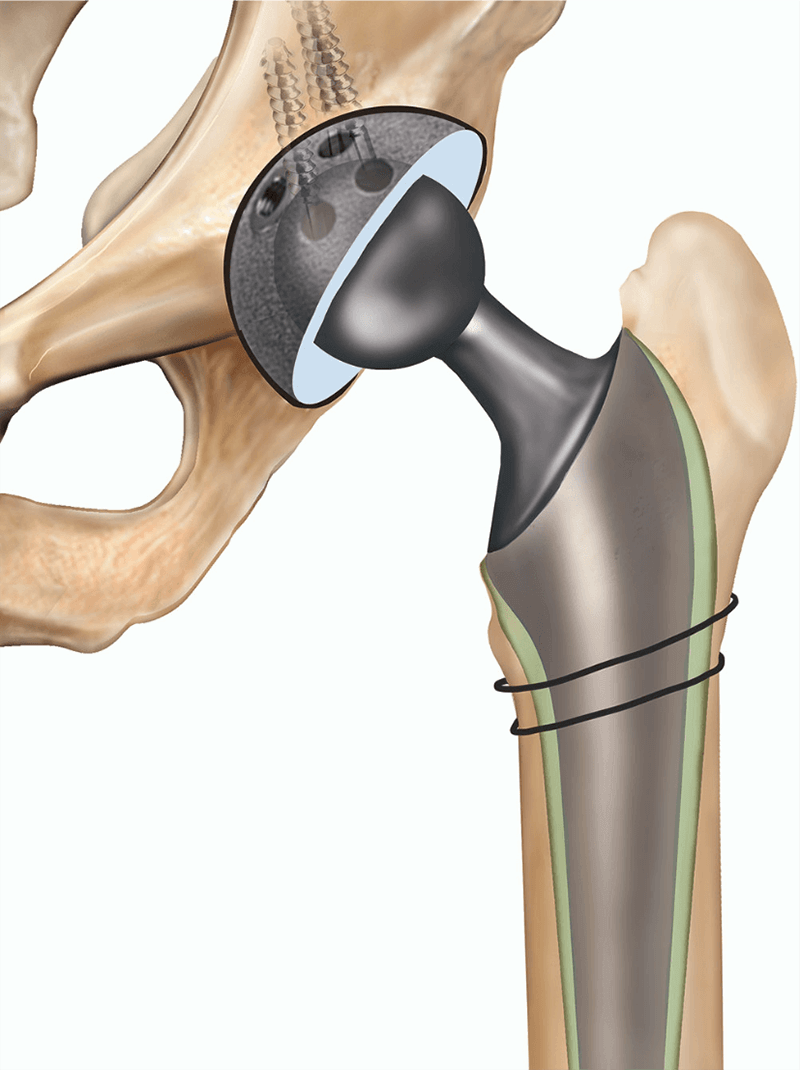 Disc Replacement/Fusion