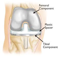 Disc Replacement/Fusion