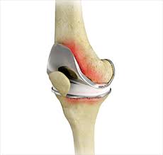 Disc Replacement/Fusion