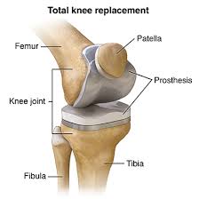Disc Replacement/Fusion