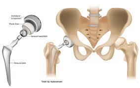 Disc Replacement/Fusion