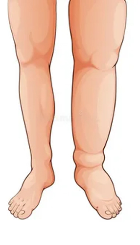 Best Hospital for Lymphedema No. 1 Lymphedema Hospital in India
