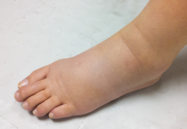 India's Most Comprehensive LymphedemaTreatment Best hospital in India for Lymphedema