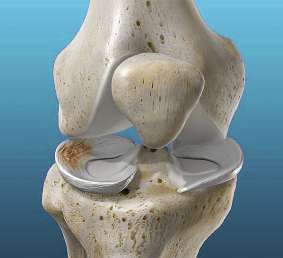 Meniscus replacement cost Chennai