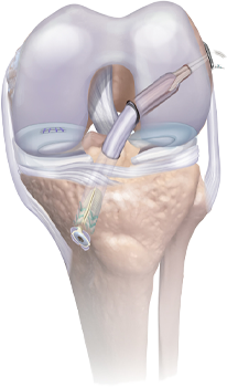 Affordable meniscus surgery Chennai