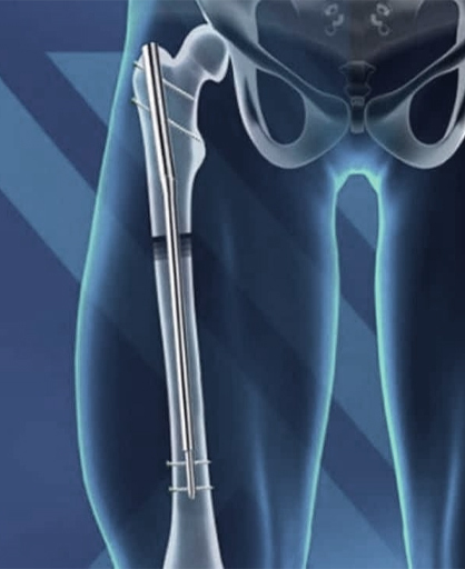 Lower limb surgery Chennai