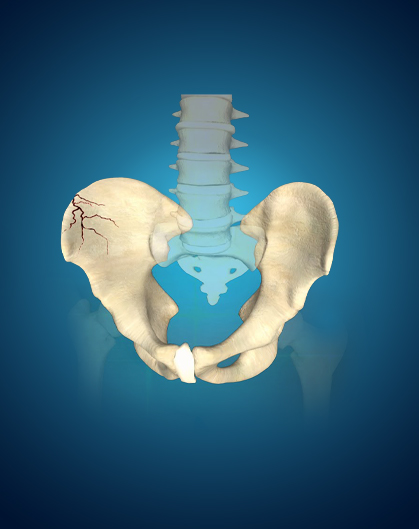Best Pelvis Fractures Hospital in India
