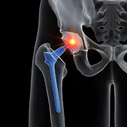 Joint Replacement Surgery