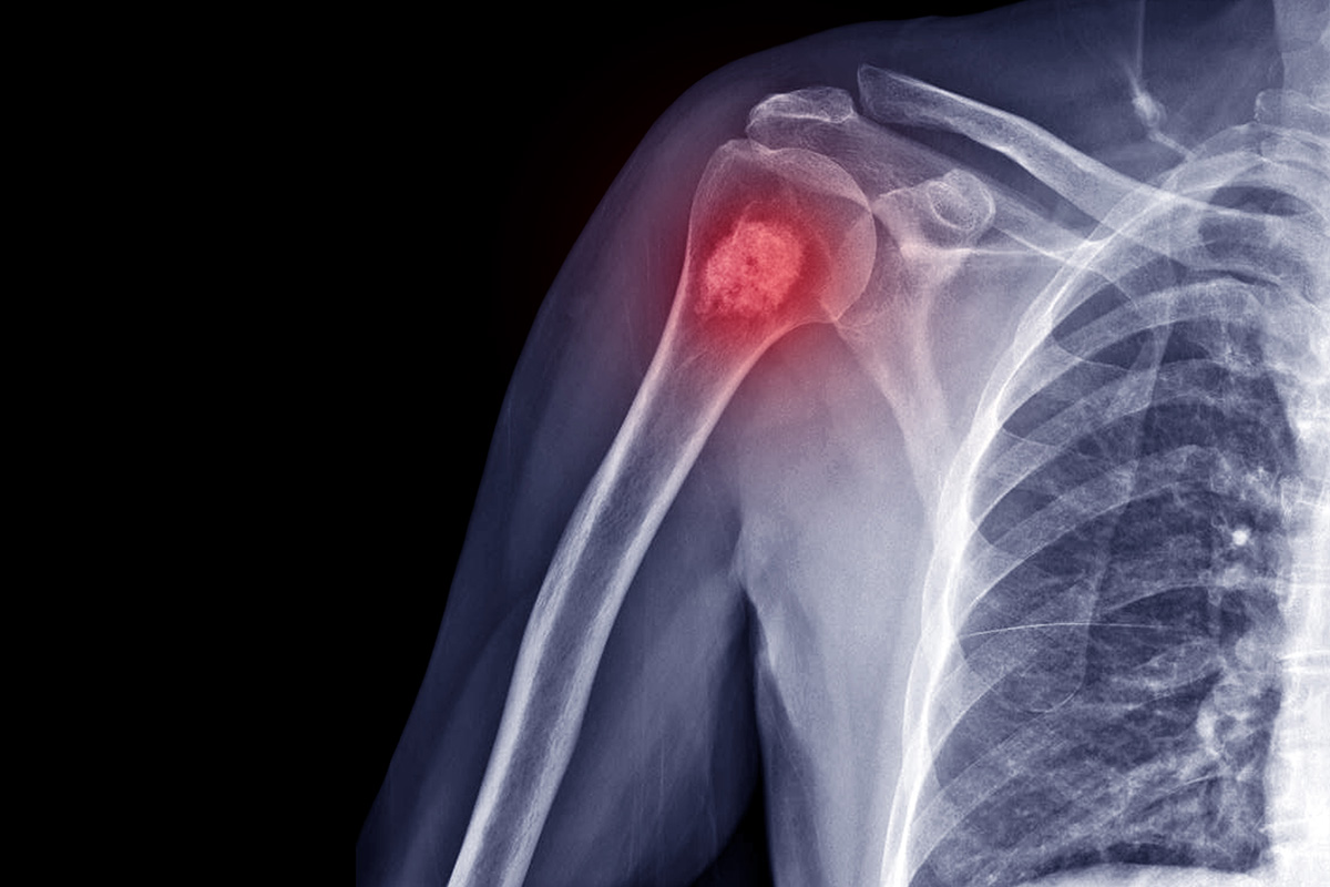 Musculoskeletal Oncology