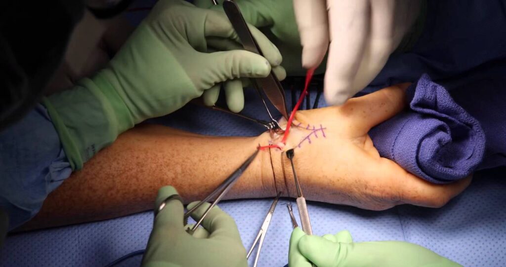 Brachial plexus